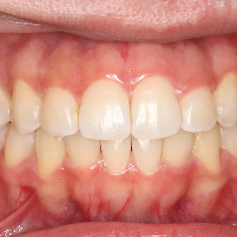 After Invisalign - Crowding & spacing correction