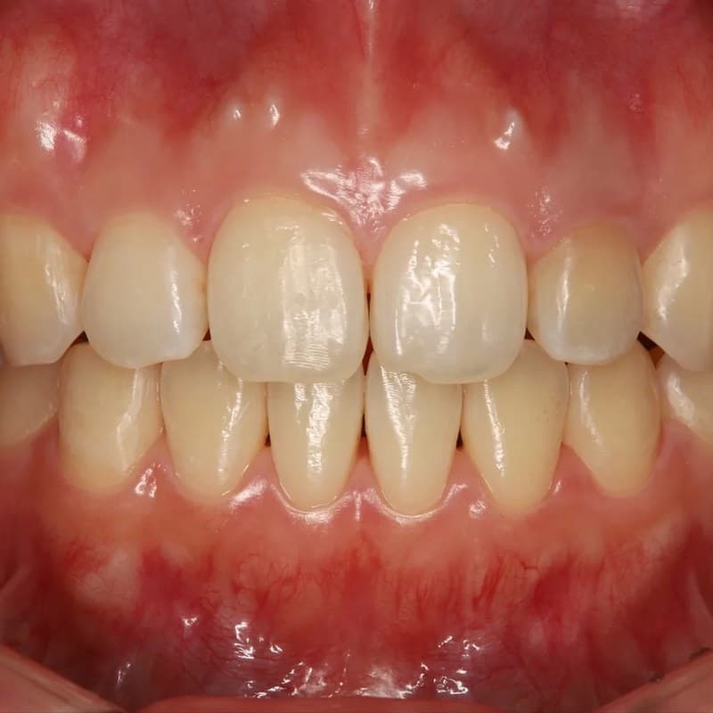 After Invisalign - Spacing & rotation