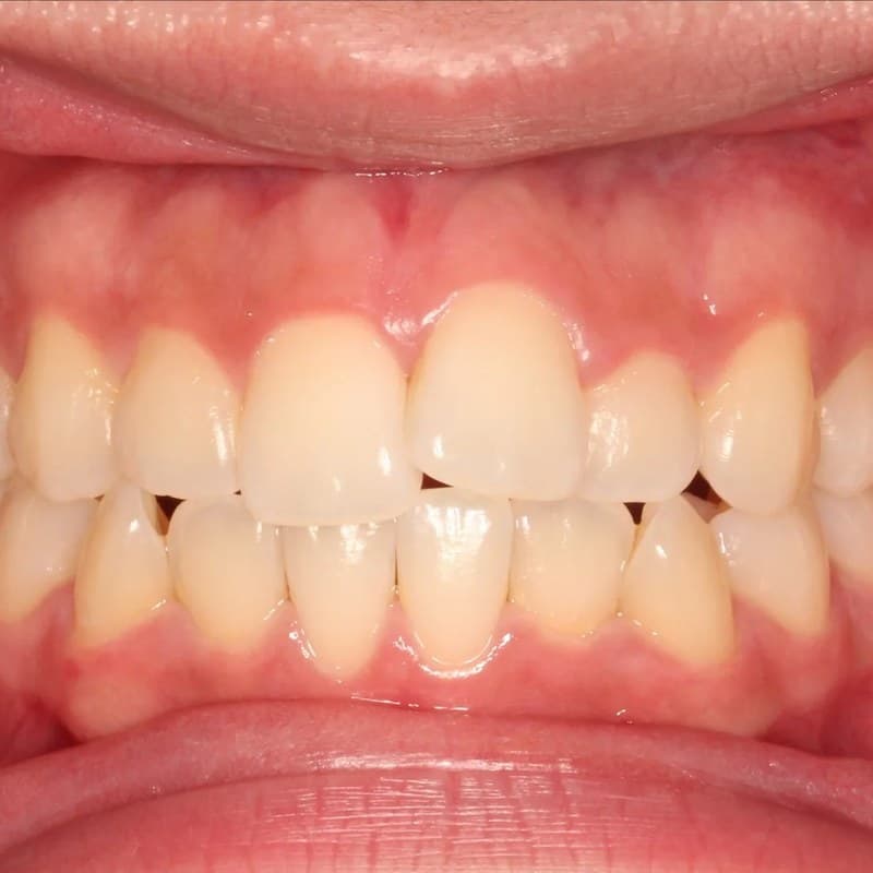 Before Invisalign - Crowding & spacing correction