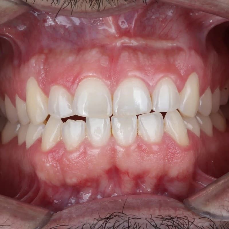 Before Invisalign - Upper & lower arch alignment