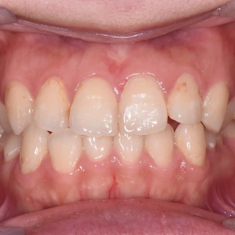 Before Invisalign - Crowding resolution