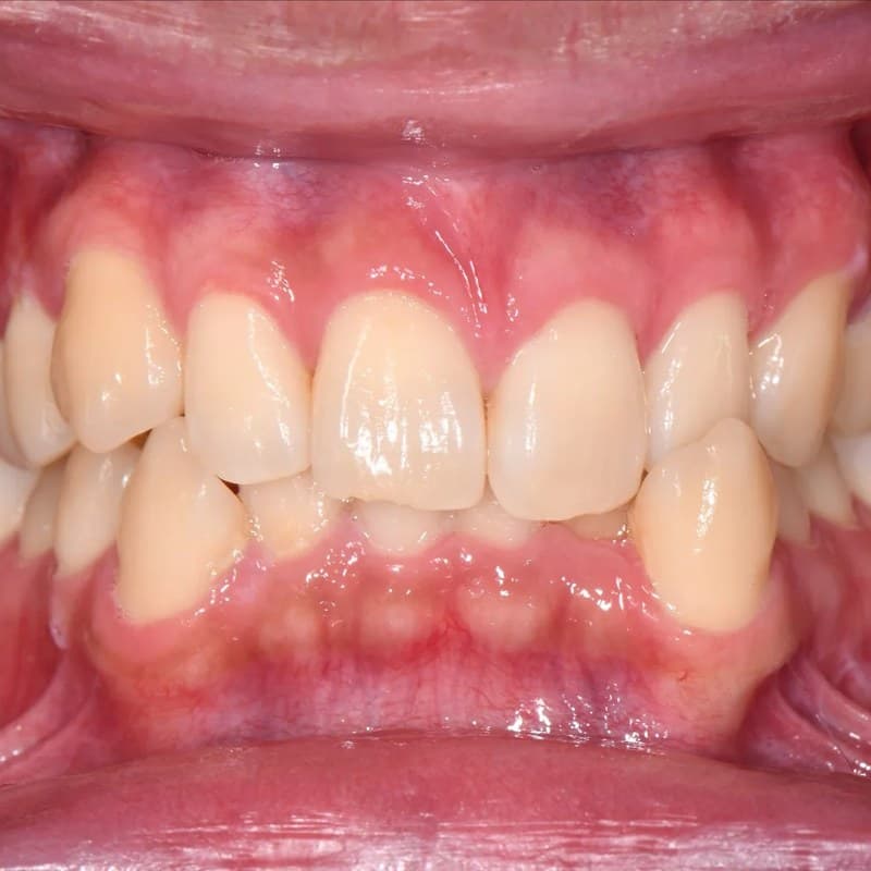 Before Invisalign - Bite correction