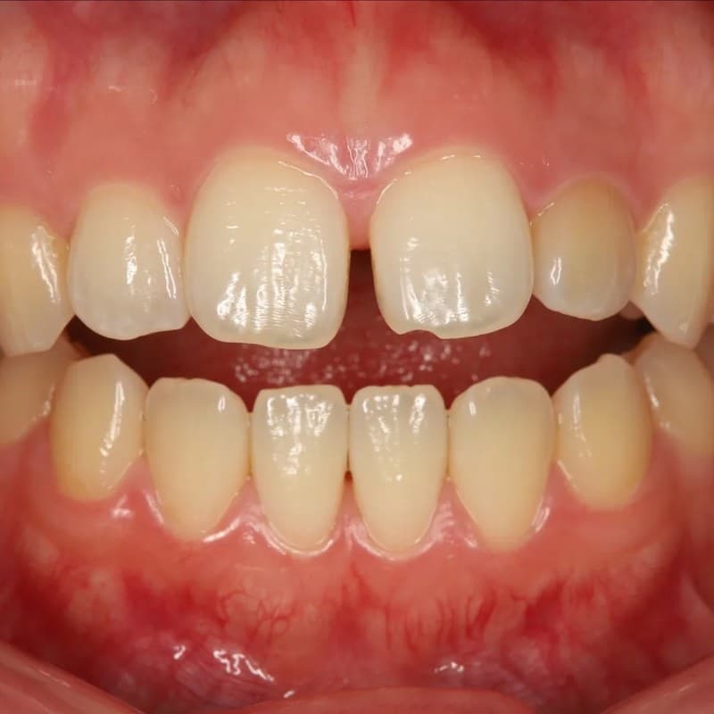Before Invisalign - Spacing & rotation