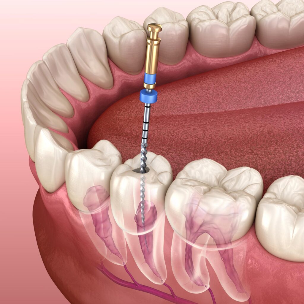 root canal treatment process