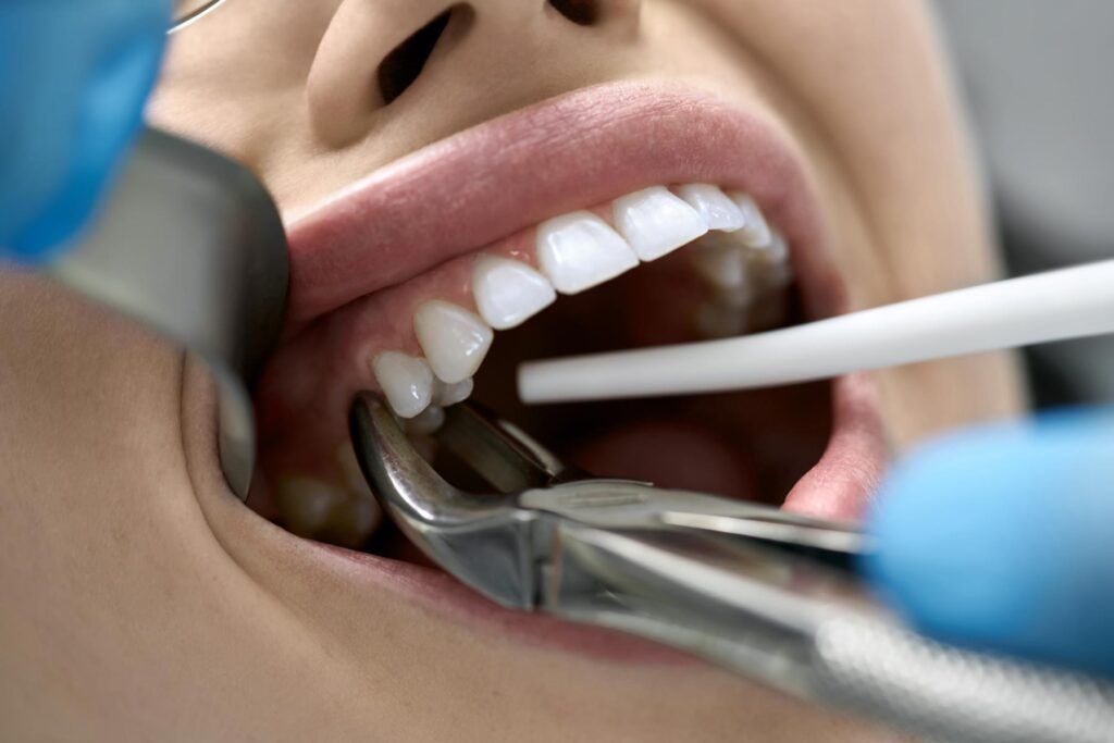 a woman's tooth getting extracted by a dentist