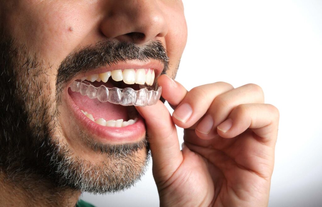 man with transparent dental retainer