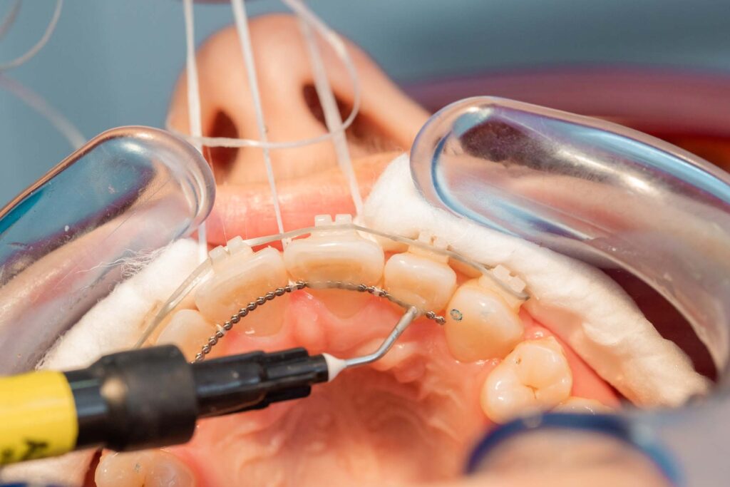 placing the fixed retainer in Process of removing dental braces