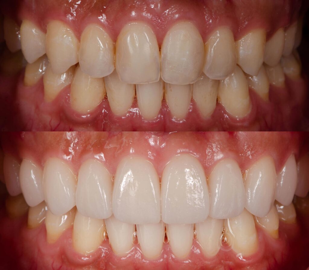 Before and After Dental smile makeover
