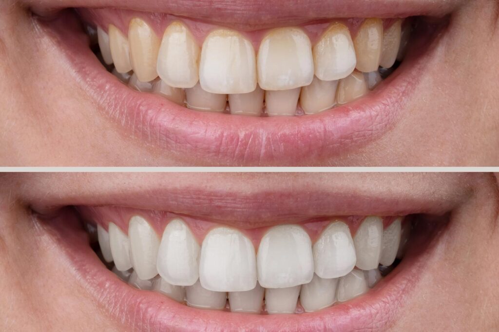before and after teeth whitening