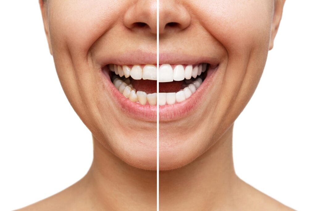 before and after dentist installs veneers on a patients teeth