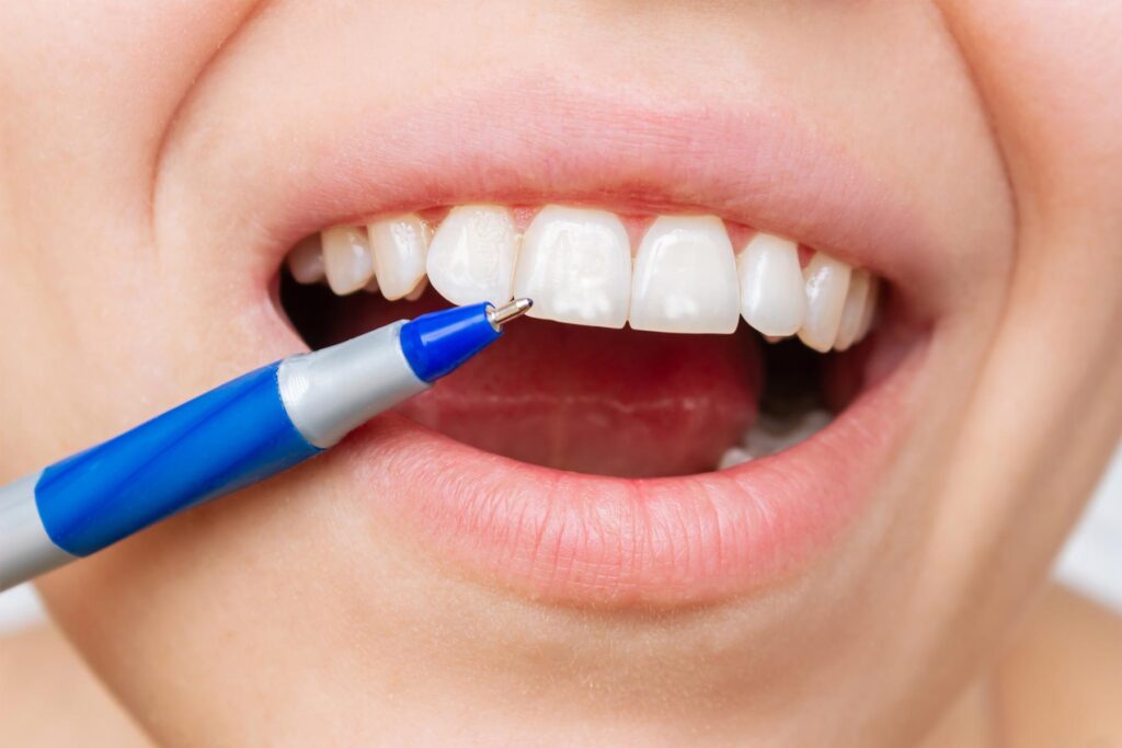 woman pointing to white spots on the tooth enamel with a pen. Requires an ICON treatment