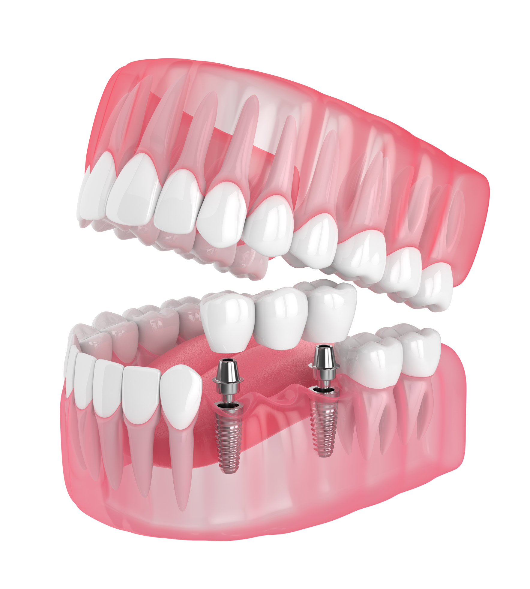 3d render of jaw with implants supported dental bridge